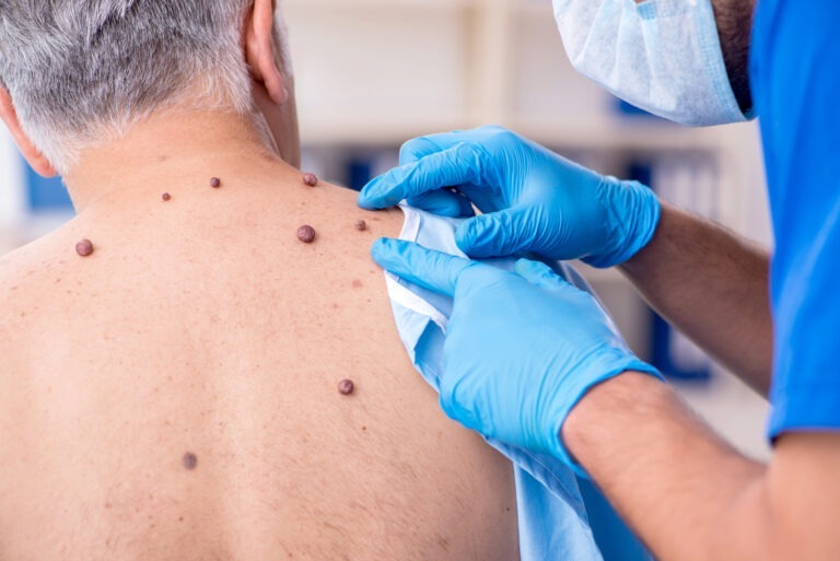 Brisbane skin doctor examining moles and skin lesions on a patient's back