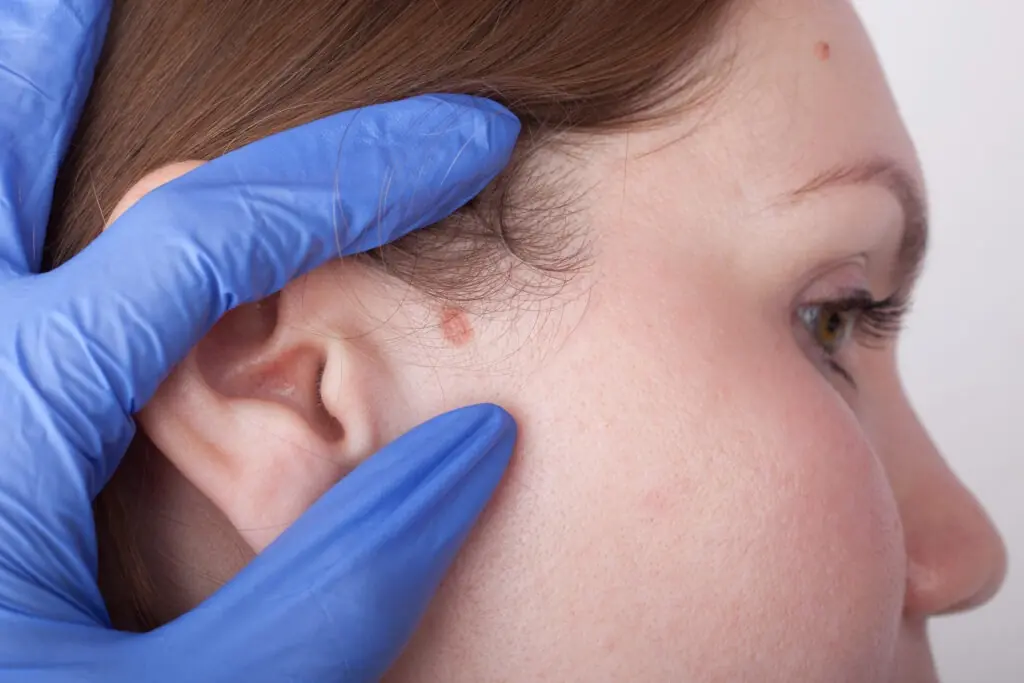 Skin cancer and lesion removal