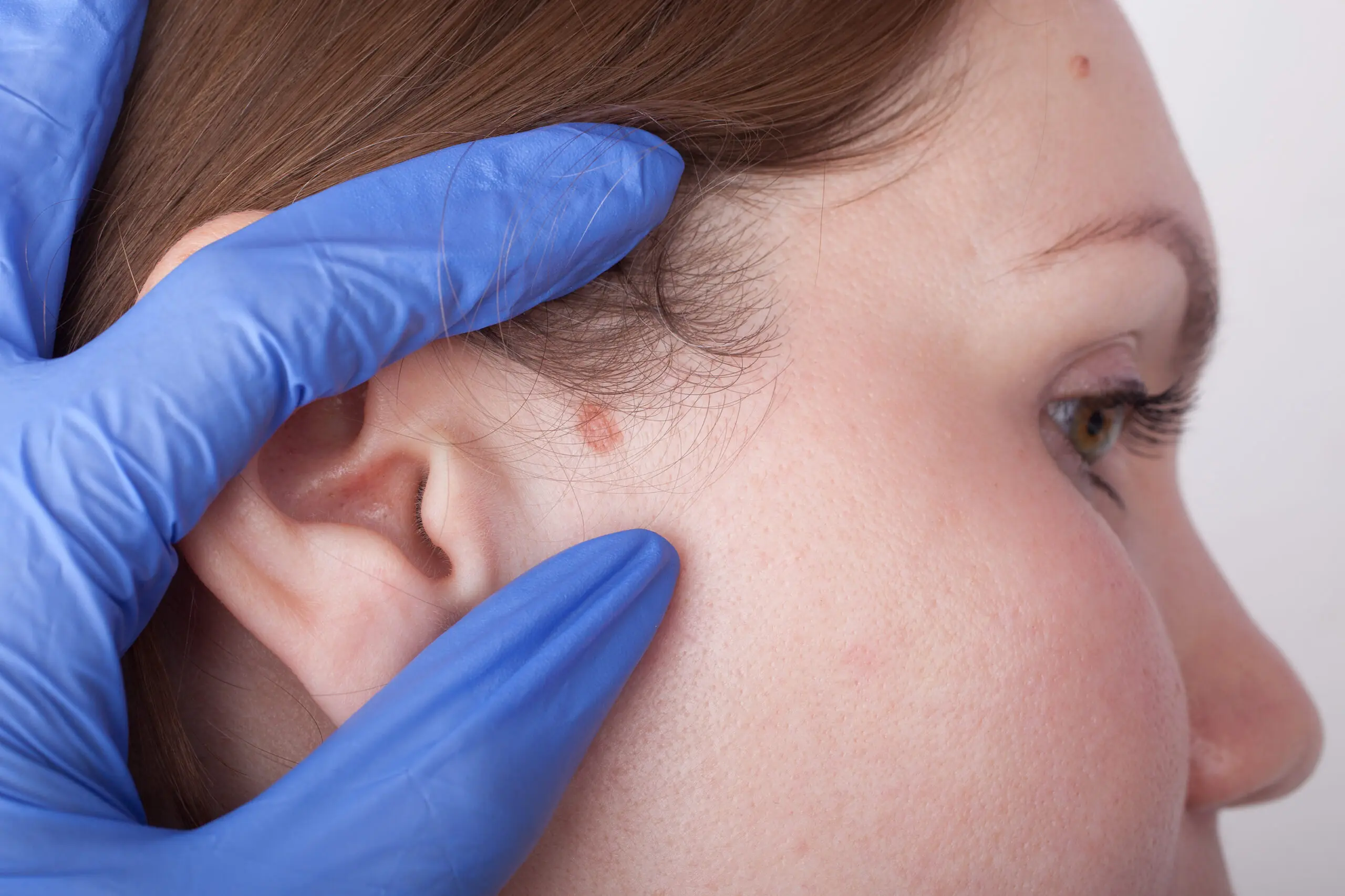 A skin cancer being assessed before surgical excision in a Brisbane clinic
