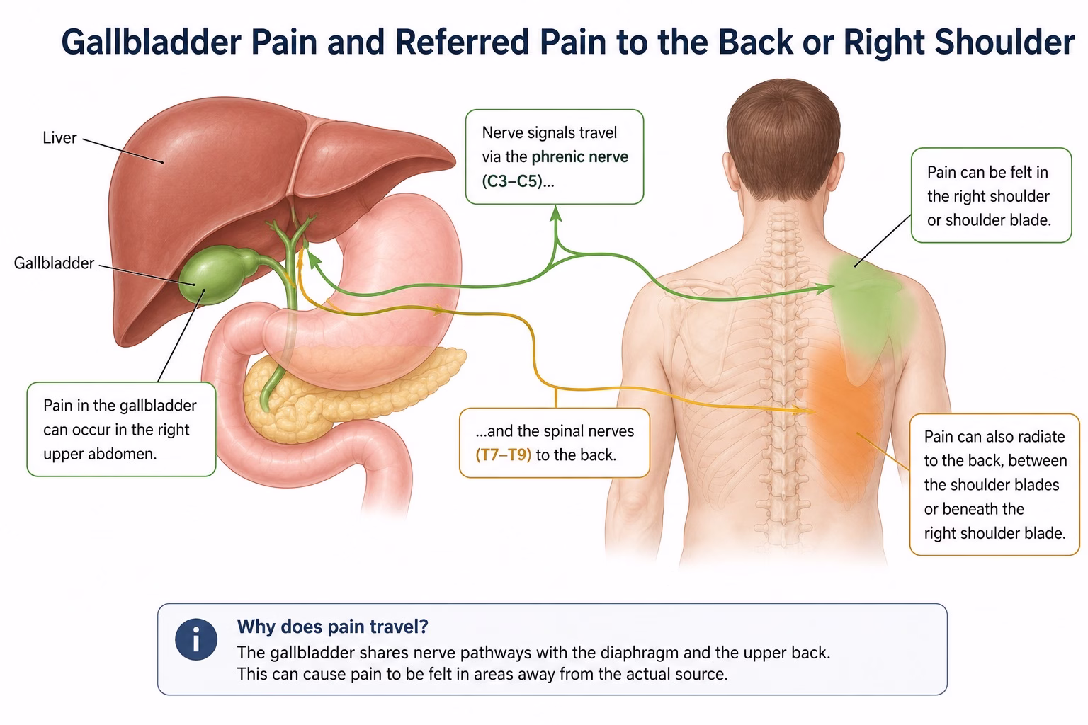 Diagram showing how gallbladder pain can travel to the back or right shoulder.