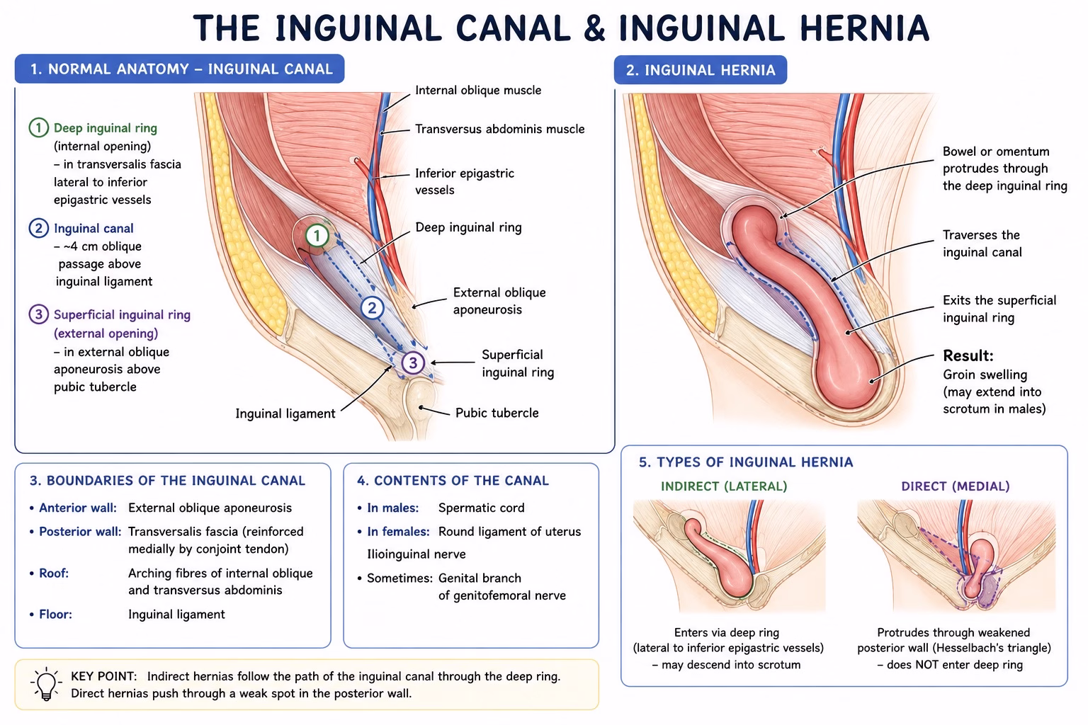 Diagram showing common inguinal and femoral hernia locations in the groin.