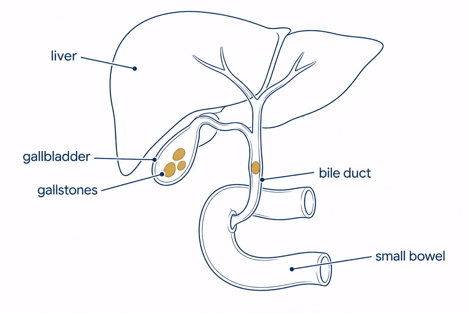 Diagram of the liver, gallbladder and bile duct showing gallstones in the gallbladder and one stone in the bile duct